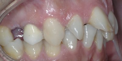 INVISALIGN IN 1